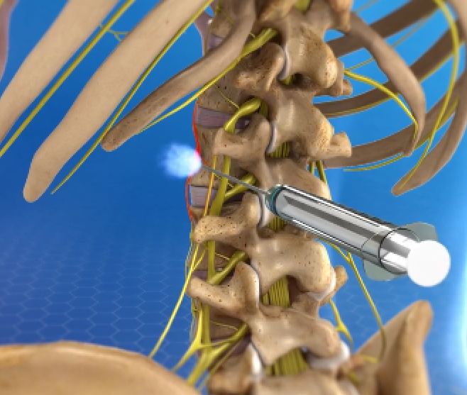 Interventional Pain Mitigation